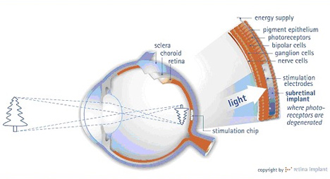 Los nuevos implantes de retina se acercan más a curar Ciegos. 1