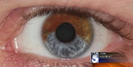 Lumineye, una nueva tecnología que transforma los ojos marrones en azules 1